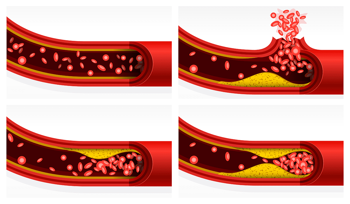 LDL as a marker for controlling atherosclerosis
